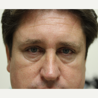 45-54 year old man treated with Eye Bags Treatment before 3837228