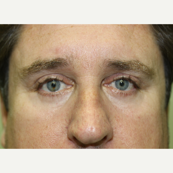45-54 year old man treated with Eye Bags Treatment after 3837228