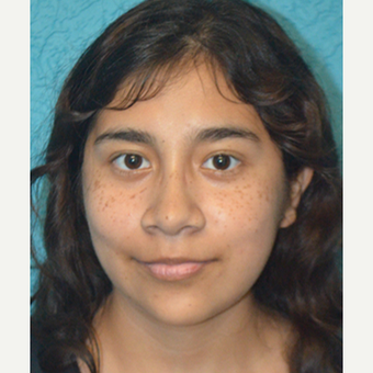 17 or under year old woman treated with Facial Reconstructive Surgery after 3696208