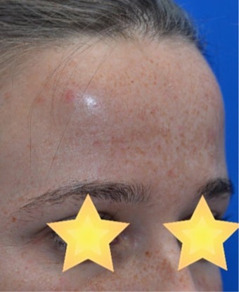 25-34 year old woman treated with Laser Resurfacing before 3141112