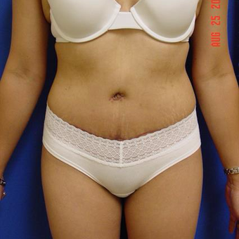 35-44 year old woman treated with Tummy after 3287693