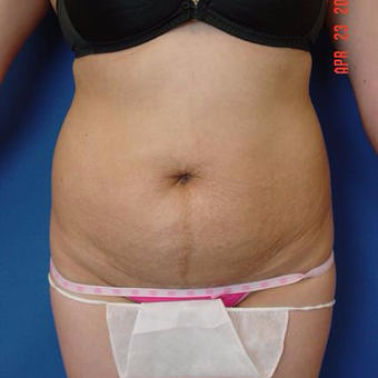 35-44 year old woman treated with Tummy before 3287693