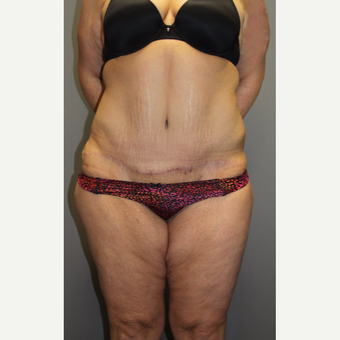 35-44 year old woman treated with Tummy Tuck after 3140822