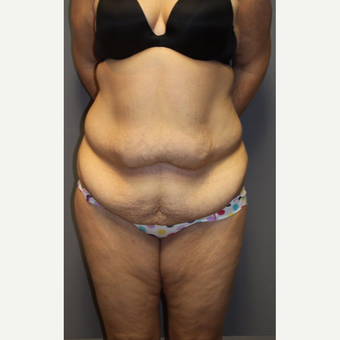 35-44 year old woman treated with Tummy Tuck before 3140822
