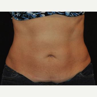 35-44 year old woman treated with CoolSculpting of the mid abdomen after 3476707
