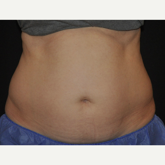 35-44 year old woman treated with CoolSculpting of the mid abdomen before 3476707