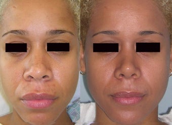 Non Caucasian Rhinoplasty - Narrowing Base Width and Increasing Tip Definition before 1247304