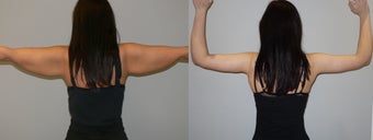 Armlift before 1153530