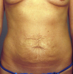 Mommy Makeover (Tummy Tuck and Conservative Breast Augmentation) before 1403118