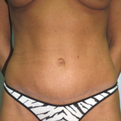 Mommy Makeover (Tummy Tuck and Conservative Breast Augmentation) after 1403118