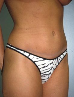 Mommy Makeover (Tummy Tuck and Conservative Breast Augmentation) 1403118