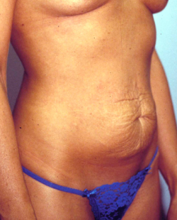 Mommy Makeover (Tummy Tuck and Conservative Breast Augmentation) 1403118