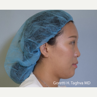 18-24 year old woman treated with Fat Transfer after 3578491