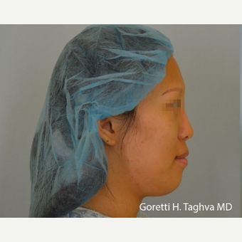 18-24 year old woman treated with Fat Transfer before 3578491