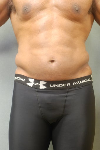 SmartLipo before 356657