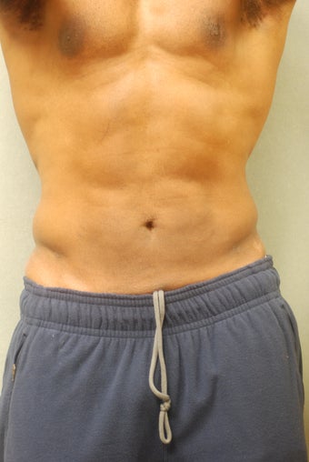 SmartLipo after 356657