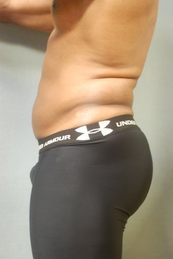 SmartLipo 356657