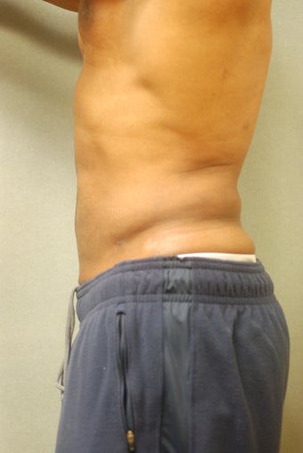 SmartLipo 356657