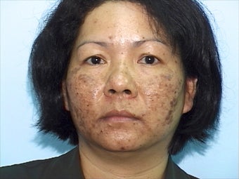 Skin Treatment Using Obagi NuDerm System before 1036745