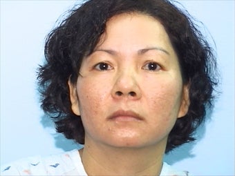 Skin Treatment Using Obagi NuDerm System after 1036745