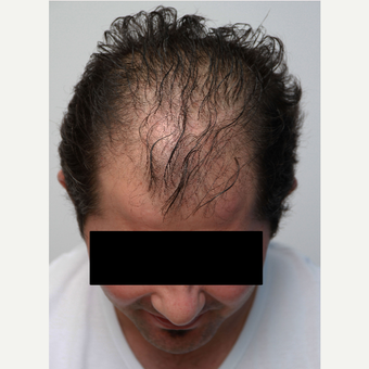 35-44 year old man treated with Organic Hair Transplant before 3172530