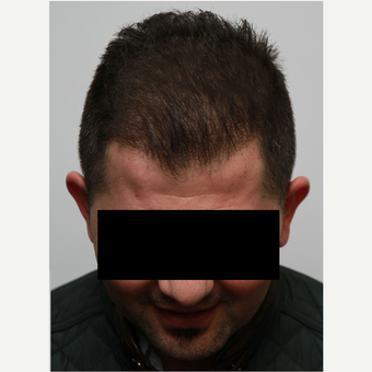 35-44 year old man treated with Organic Hair Transplant after 3172530