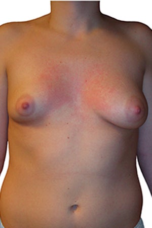 Tuberous Breast Reconstruction and Augmentation before 330636