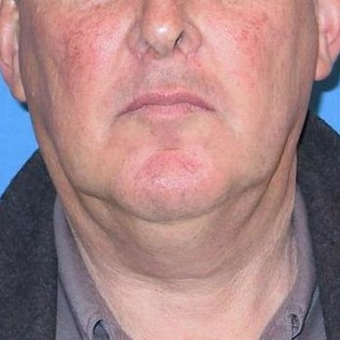 55-64 year old man treated with Neck Lift before 3497056