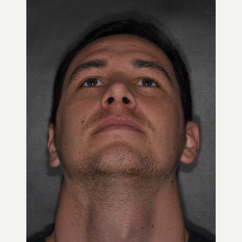 18-24 year old man treated with Nose Surgery 6 weeks post-op after 3499677