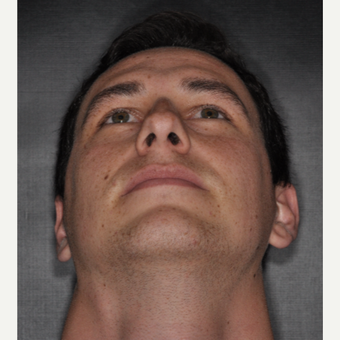 18-24 year old man treated with Nose Surgery 6 weeks post-op before 3499677