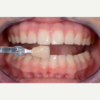 18-24 year old woman treated with Zoom Whitening before 3736105