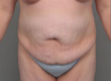 45-54 year old woman treated with Tummy Tuck before 3287377