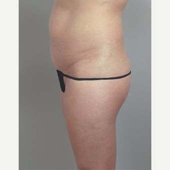 25-34 year old woman treated with Brazilian Butt Lift after Tummy Tuck before 3213392