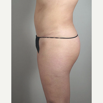 25-34 year old woman treated with Brazilian Butt Lift after Tummy Tuck after 3213392