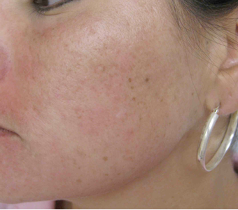 Acne scarring treated with filler after 821646