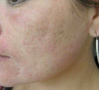 Acne scarring treated with filler before 821646