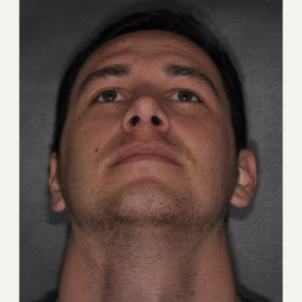 18-24 year old man treated with Septoplasty 6 weeks post-op after 3499649