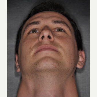 18-24 year old man treated with Septoplasty 6 weeks post-op before 3499649