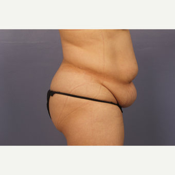35-44 year old woman treated with Drainless Tummy Tuck before 3500972