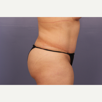 35-44 year old woman treated with Drainless Tummy Tuck after 3500972