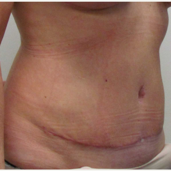 Tummy Tuck for this 42 Year Old Woman after 3092481