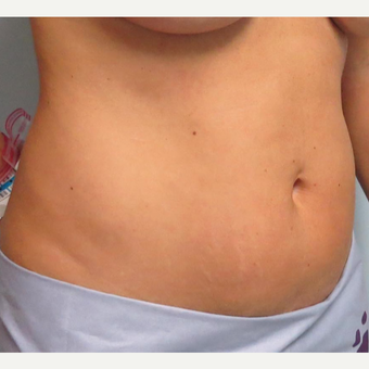 Tummy Tuck for this 42 Year Old Woman before 3092481