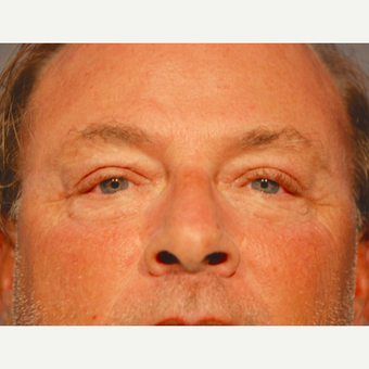 55-64 year old man treated with Eyelid Surgery after 3129758