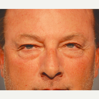 55-64 year old man treated with Eyelid Surgery before 3129758
