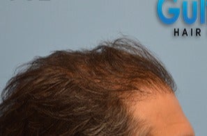 35-44 year old man treated with FUE Hair Transplant before 3604725