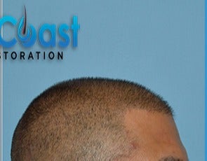 35-44 year old man treated with FUE Hair Transplant after 3604725