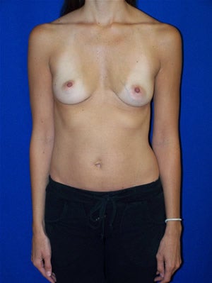 Breast Augmentation before 89634