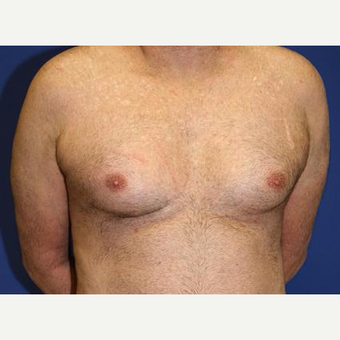 45-54 year old man treated with Male Breast Reduction before 3093262