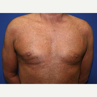 45-54 year old man treated with Male Breast Reduction after 3093262