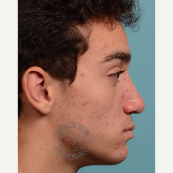 17 or under year old man treated with Septoplasty/open rhinoplasty after 3108917
